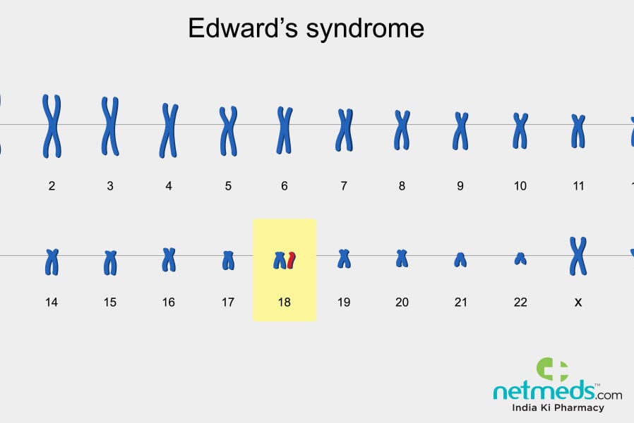edward's syndrome