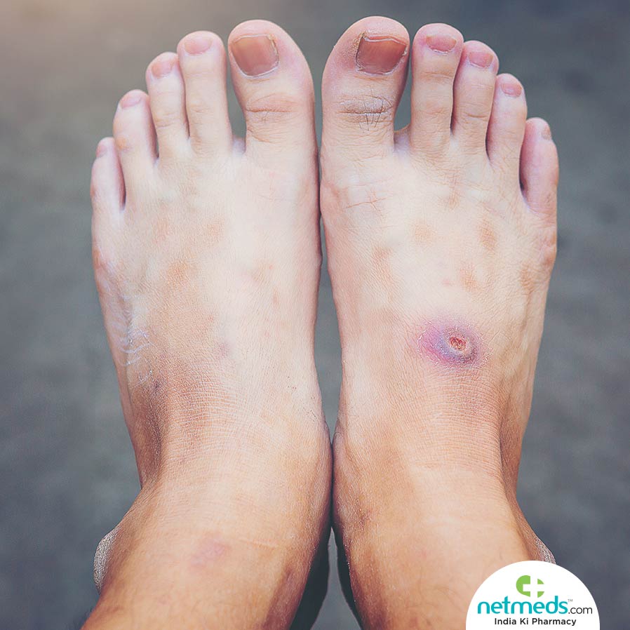 Gangrene 