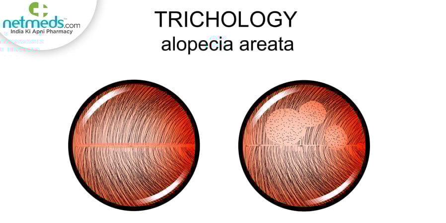 Alopecia areata