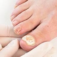Fungal Nail Infection: Causes, Symptoms And Treatment