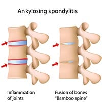 Ankylosing Spondylitis: Causes, Symptoms And Treatment