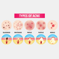 Types Of Acne: Know The Difference Between Blackheads, Whiteheads, Nodules And Cysts