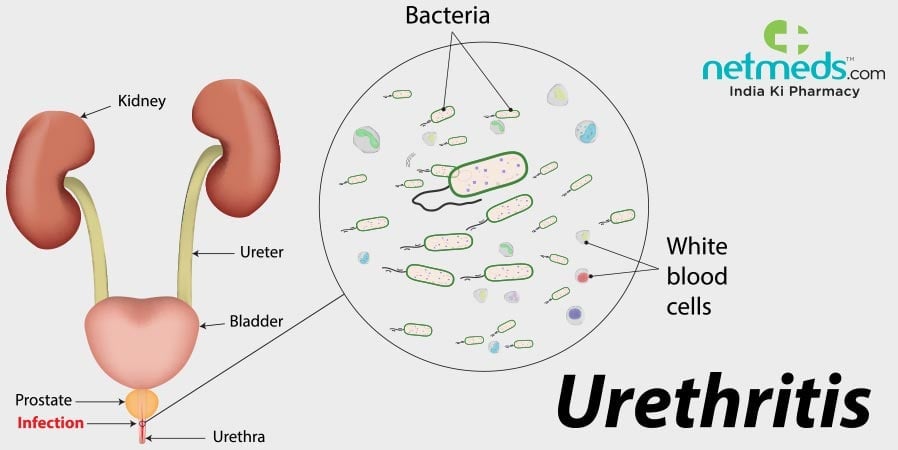 Urethritis