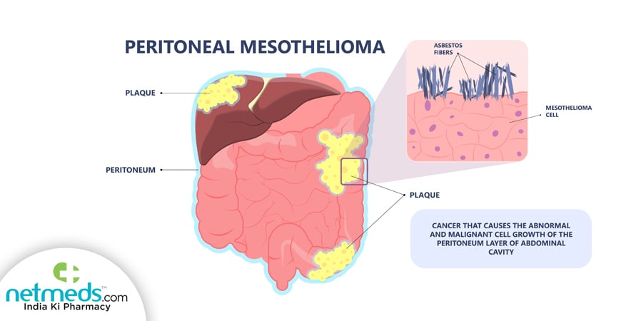 peritoneal carcinoma