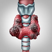 Hurthle Cell Cancer: Causes, Symptoms And Treatment