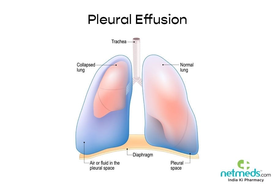 Pleural effusion