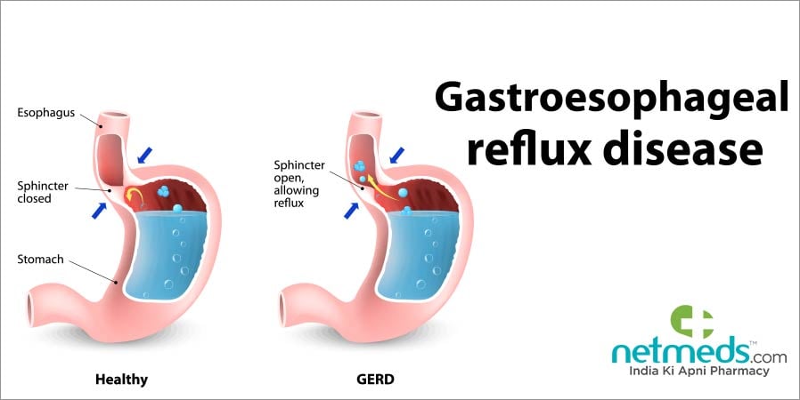 Gastroesophageal Reflux Disease