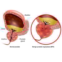Sex Post Prostatectomy: Do's and Dont’s To Restore Physical Intimacy With Your Partner