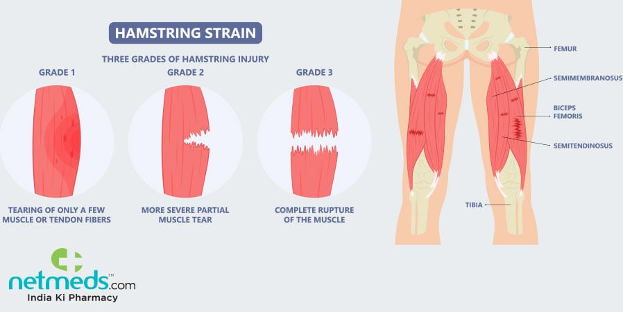 Hamstring strain