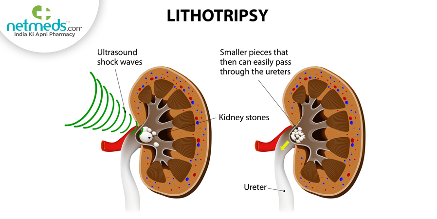 Lithotripsy