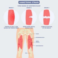 Hamstring Injury: Causes, Symptoms And Treatment