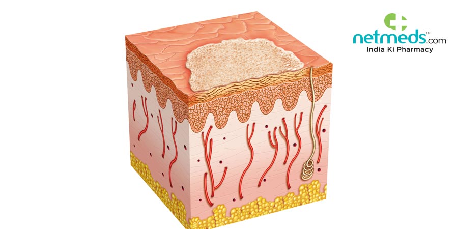 Merkel Cell Carcinoma