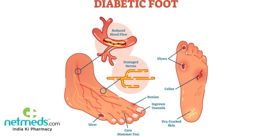 Diabetes Foot Care