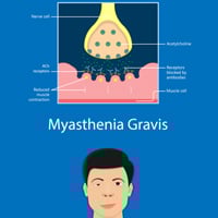 Myasthenia Gravis: Causes, Symptoms And Treatment Of This Autoimmune Disorder