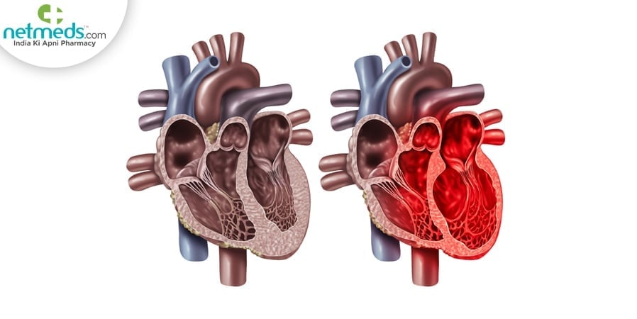 Broken heart syndrome