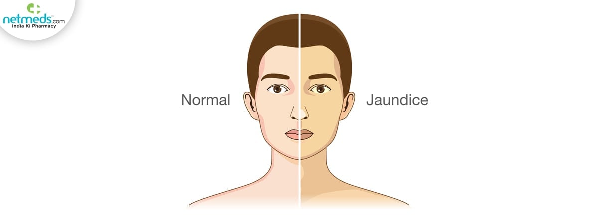 jaundice