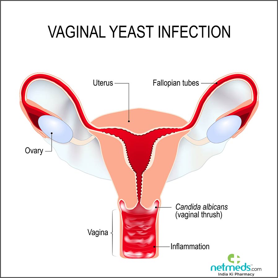 vaginal yeast infection